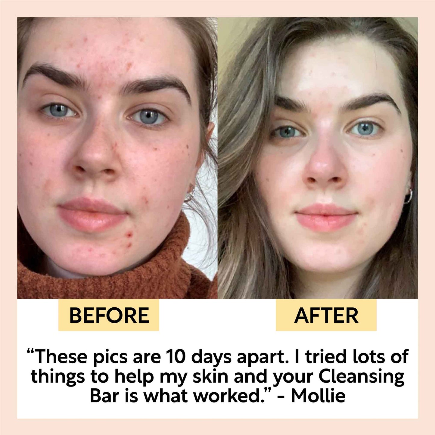 Acne-Prone Skincare Bundle