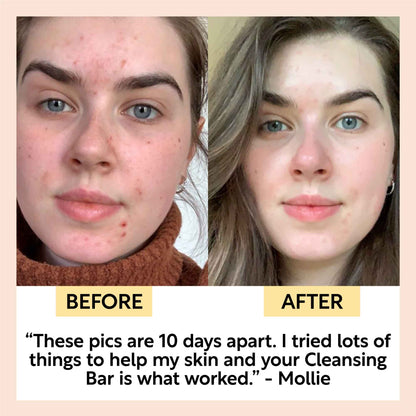 Acne-Prone Skincare Bundle