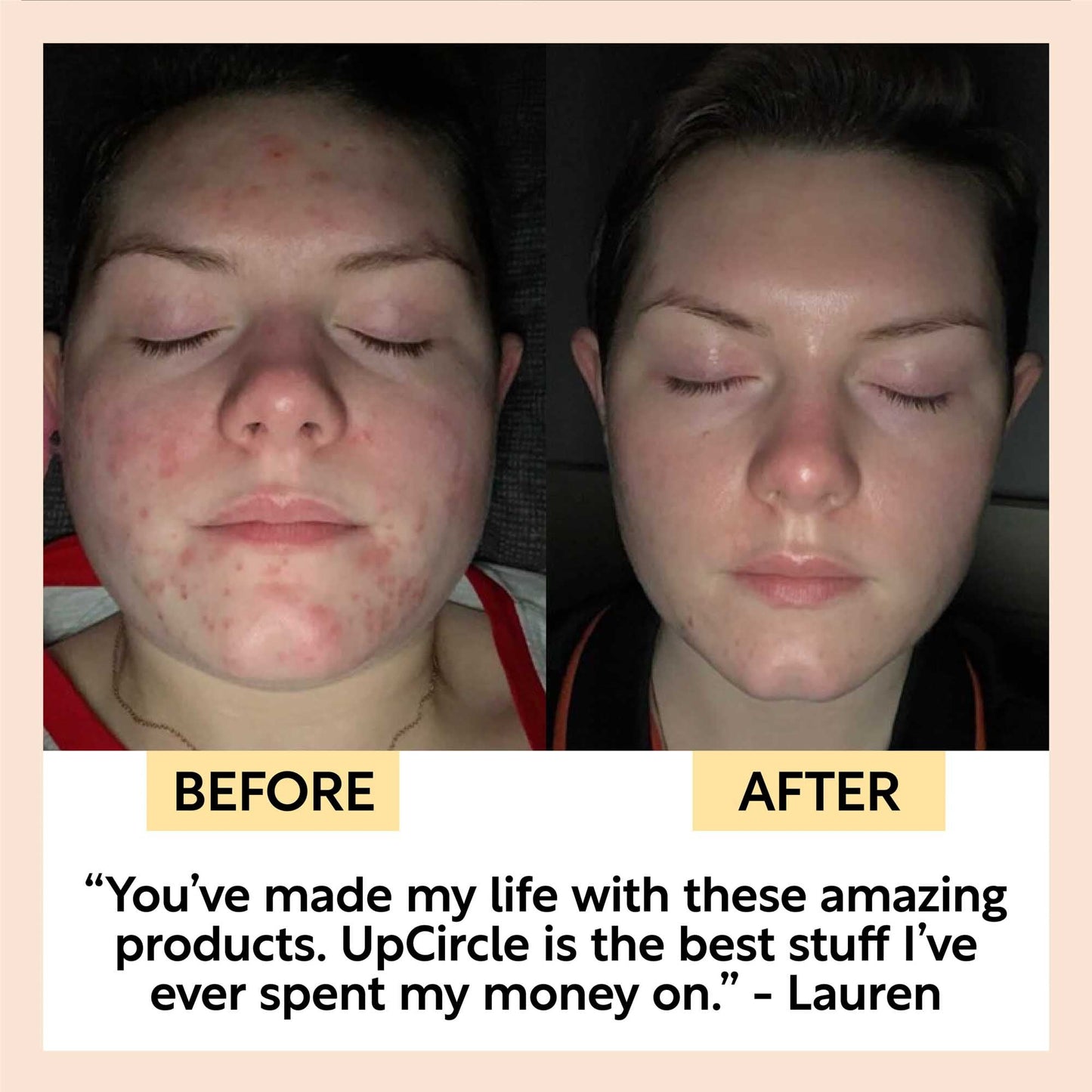 Acne-Prone Skincare Bundle