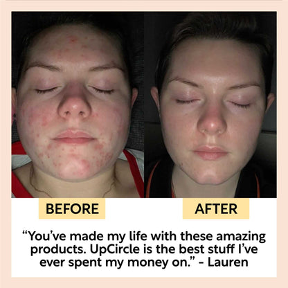 Acne-Prone Skincare Bundle